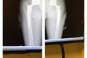 Hip Replacement Update: Scar and X-ray Pictures.