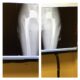 Hip Replacement Update: Scar and X-ray Pictures.