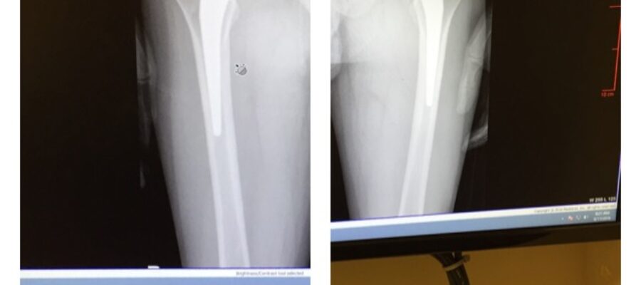 Hip Replacement Update: Scar and X-ray Pictures.