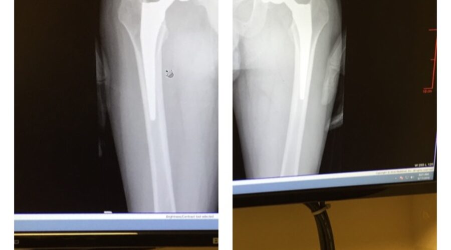 Hip Replacement Update: Scar and X-ray Pictures.